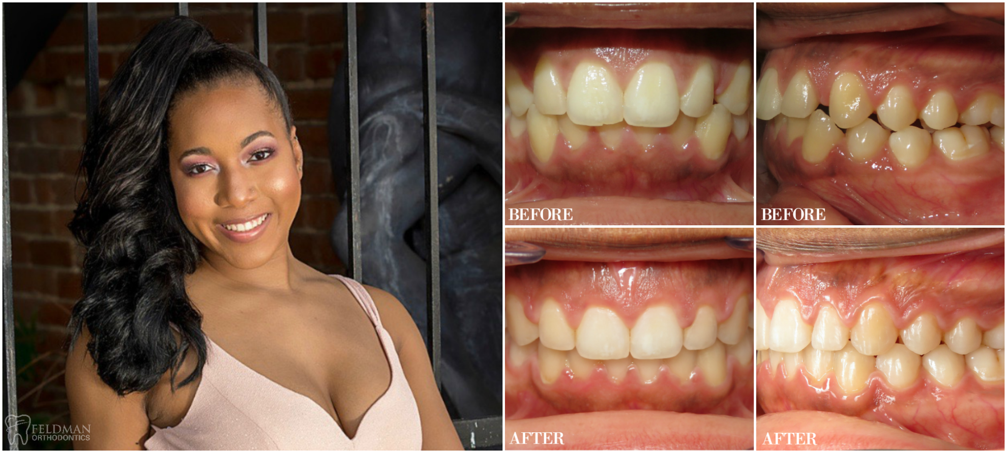 Before And After Feldman Orthodontics